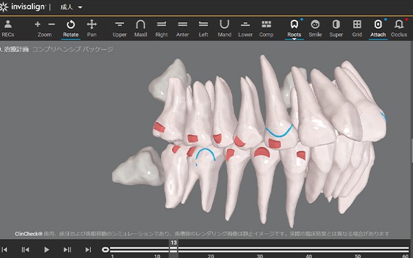 歯根データ付き3次元的治療計画（クリンチェック）