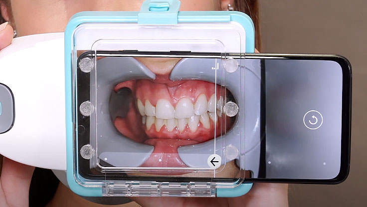 前歯から奥歯の咬み合わせまで歯並び全体が撮影できるよう、画面下の矢印に従ってスキャンボックスを動かします。