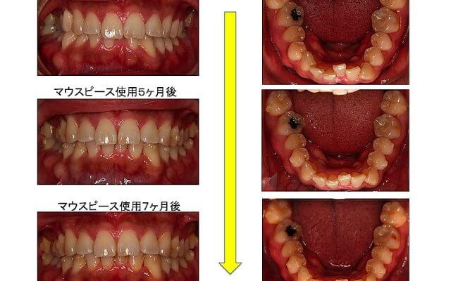 矯正治療の途中経過 仙台の矯正治療ならくぼた矯正歯科クリニック