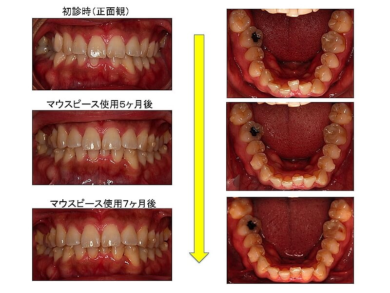 矯正治療の途中経過 仙台の矯正歯科 マウスピース矯正 くぼた矯正歯科クリニック