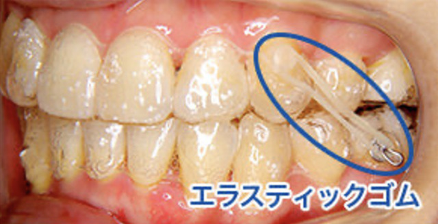 歯科矯正 顎間ゴム ゴムかけ 歯並び エラスティック ワイヤー インビザライン